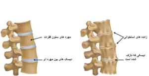 آرتروز گردن در سالمندان چگونه درمان میشود؟ 3 ارتروز گردن